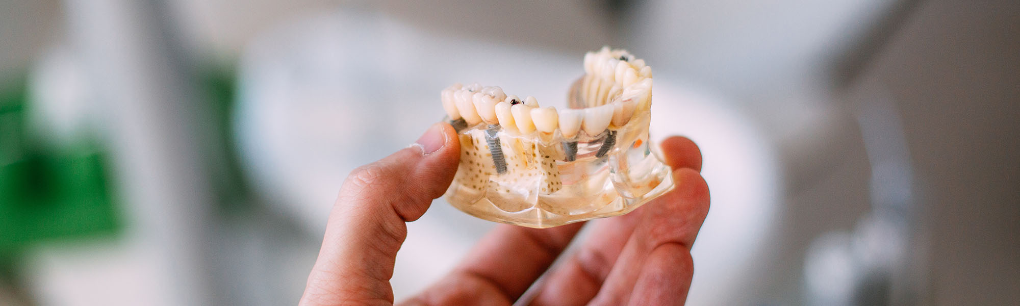 Dental Implants Montclair CA