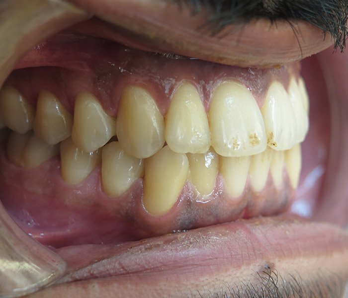 Before deep dental cleaning at Dentist of Montclair