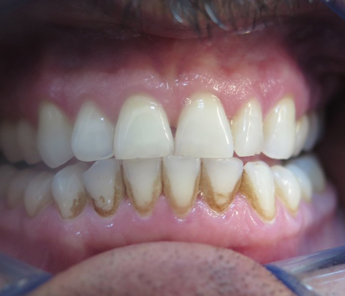 Before tartar removal and polishing at Dentist of Montclair