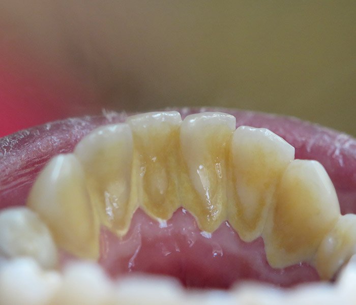 Before plaque and stain removal at Dentist of Montclair