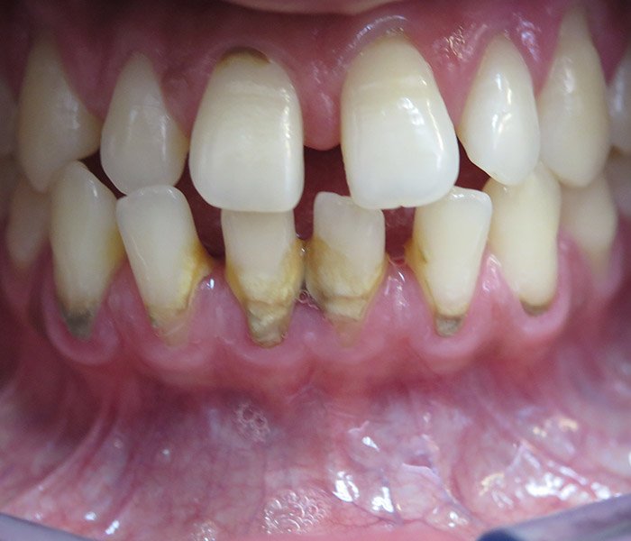 Before professional teeth cleaning at Dentist of Montclair