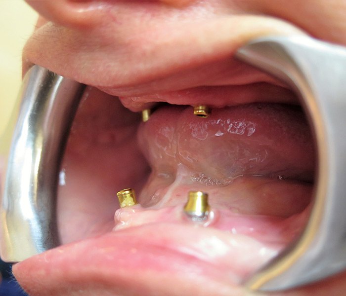 Before all-on-4 smile restoration at Dentist of Montclair