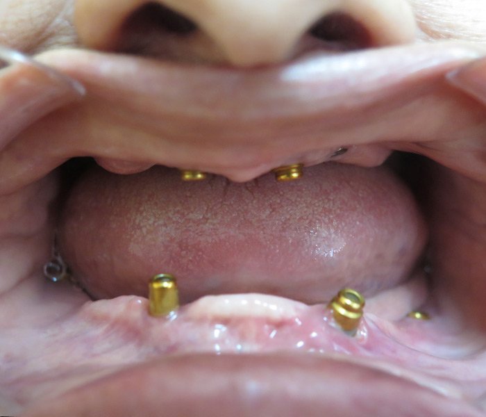 Before all-on-4 implant treatment at Dentist of Montclair