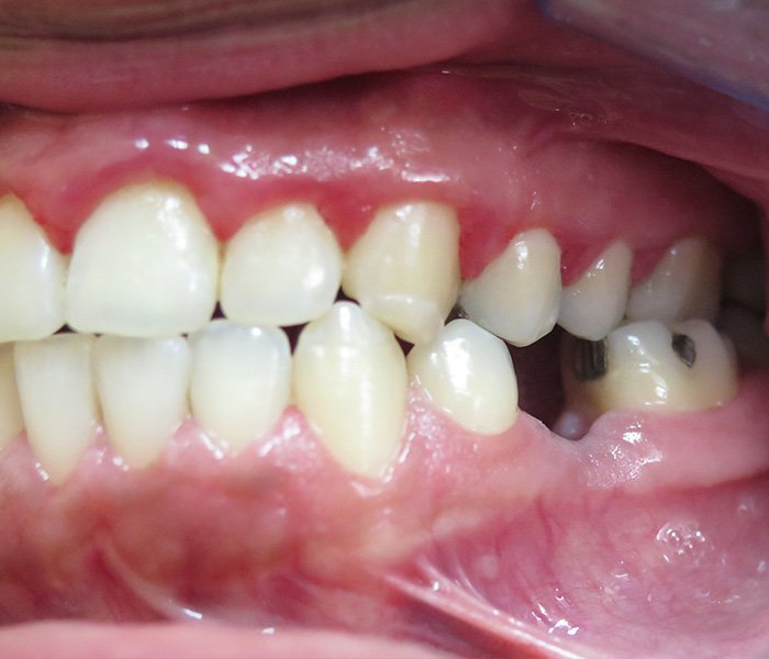 Before multiple dental implants at Dentist of Montclair