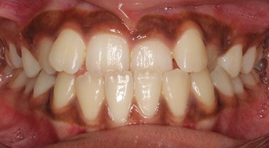 Before orthodontic teeth straightening at Dentist of Montclair