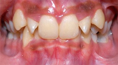Before braces orthodontic treatment at Dentist of Montclair