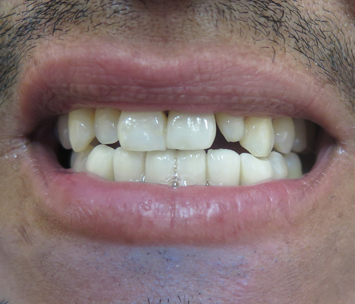 Before cosmetic veneers treatment at Dentist of Montclair