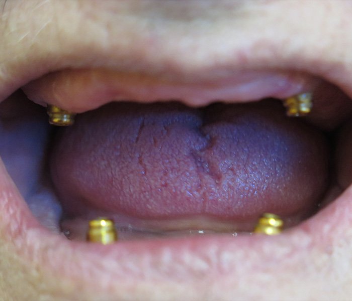 Before all-on-4 dental implants at Dentist of Montclair