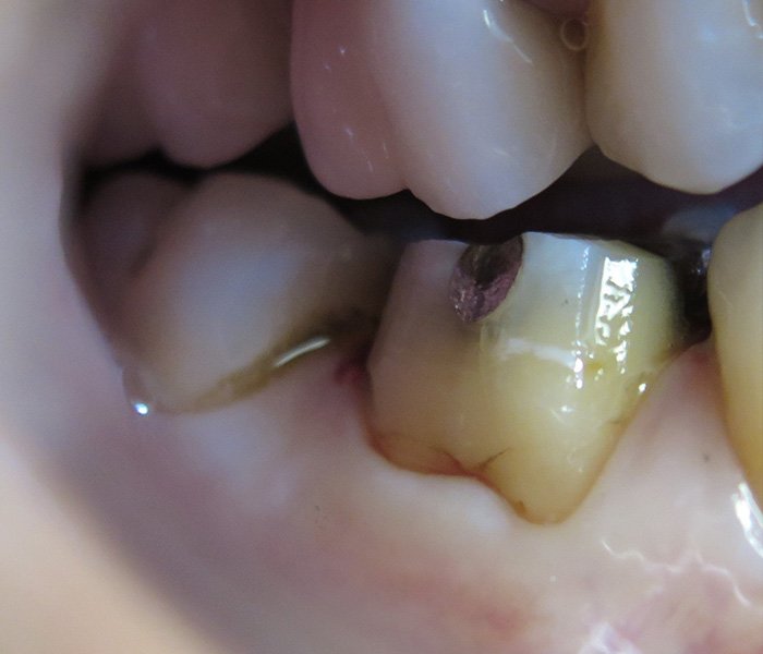 Before dental crown treatment at Dentist of Montclair
