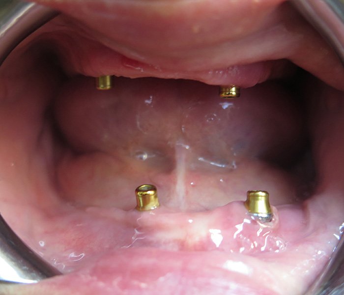 Before full arch all-on-4 treatment at Dentist of Montclair