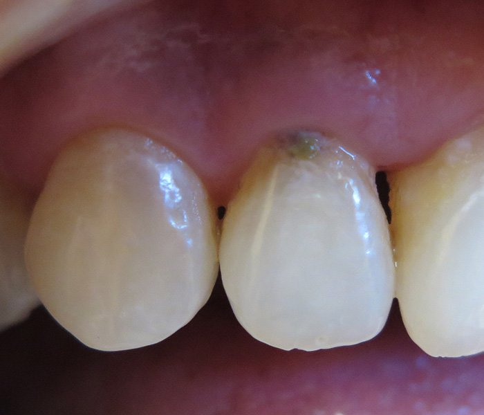 Before decayed teeth restored with composite fillings at Dentist of Montclair