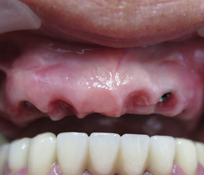 Before full dental implant restoration at Dentist of Montclair