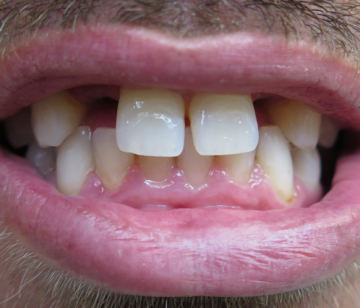 Before implant-supported smile makeover at Dentist of Montclair