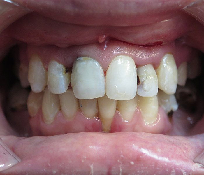 Before single dental implant treatment at Dentist of Montclair