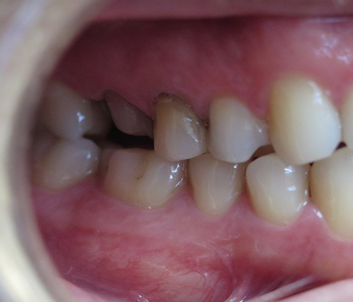 Before front tooth dental crown at Dentist of Montclair