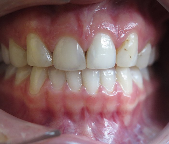 Before porcelain veneer smile makeover at Dentist of Montclair