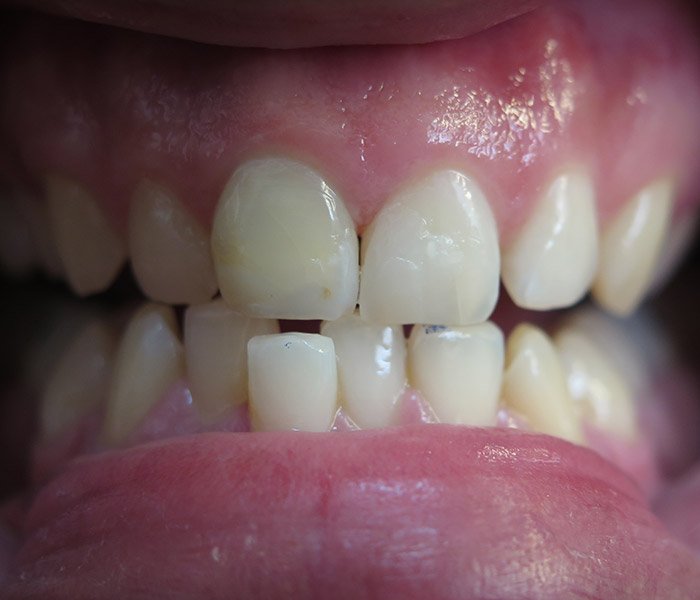 After composite tooth-colored fillings at Dentist of Montclair