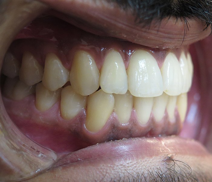 After deep dental cleaning at Dentist of Montclair