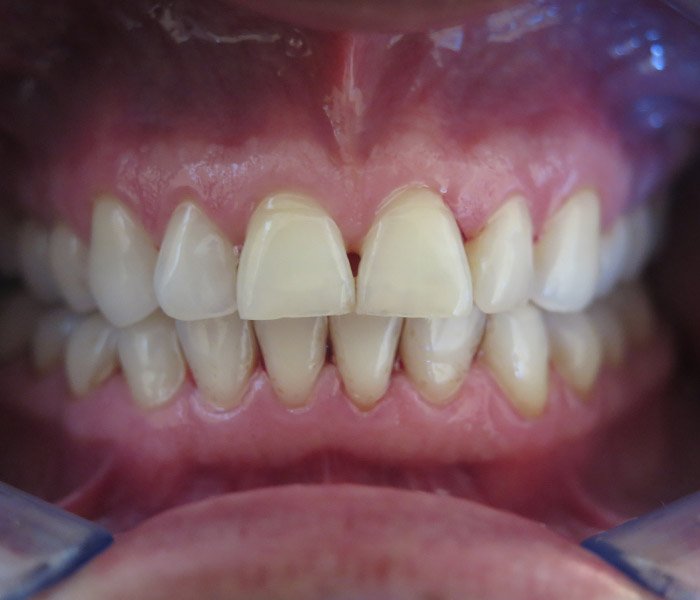 After tartar removal and polishing at Dentist of Montclair