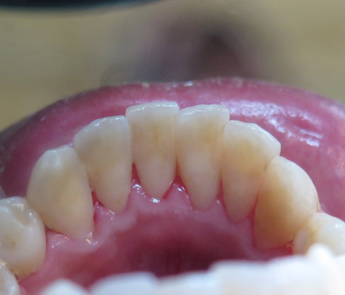 After plaque and stain removal at Dentist of Montclair