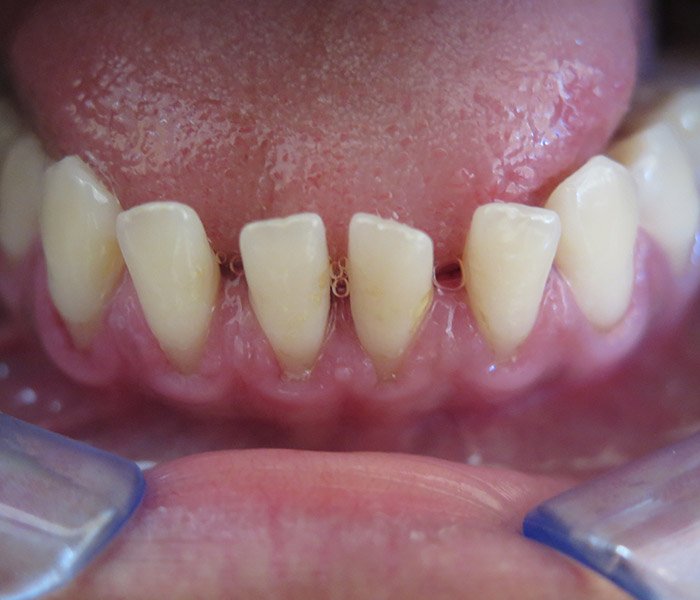 After professional teeth cleaning at Dentist of Montclair