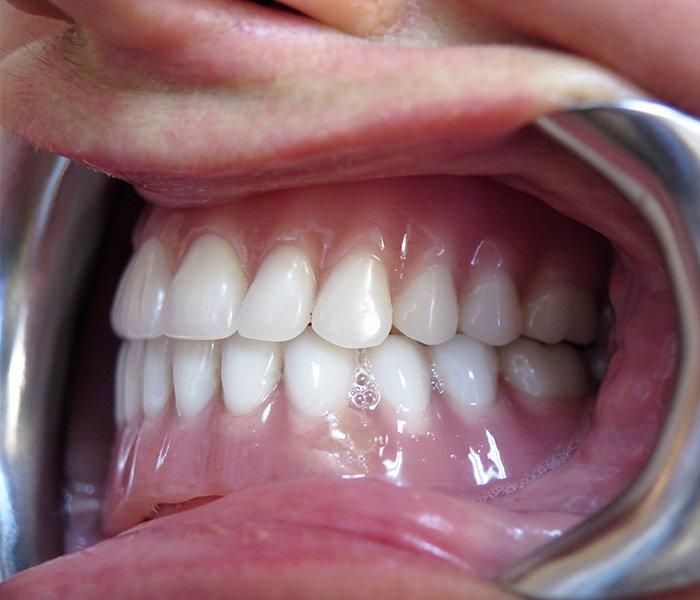 After all-on-4 smile restoration at Dentist of Montclair