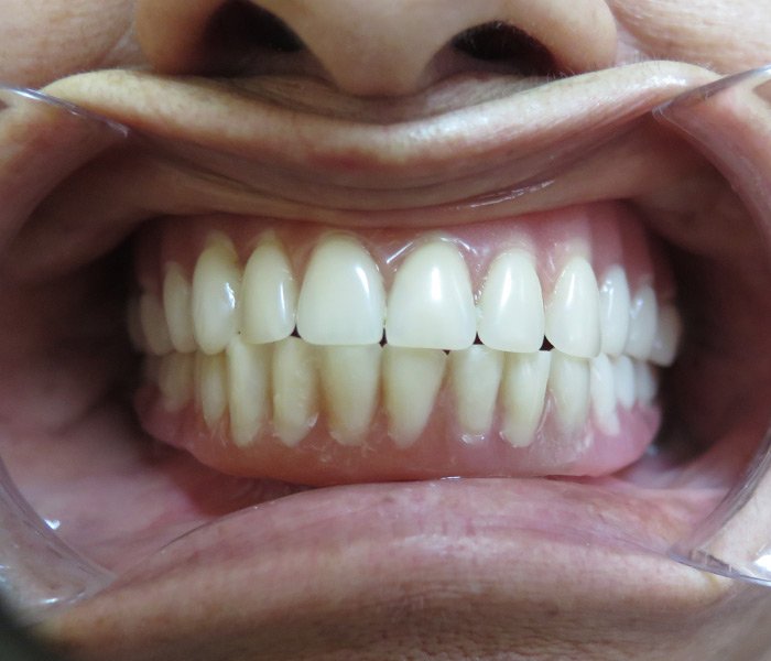 After all-on-4 implant treatment at Dentist of Montclair