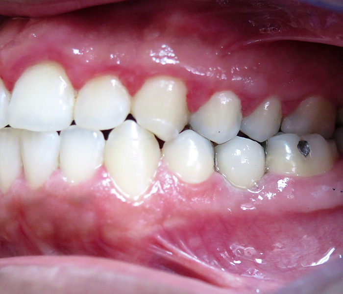 After multiple dental implants at Dentist of Montclair