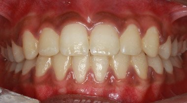 After orthodontic teeth straightening at Dentist of Montclair
