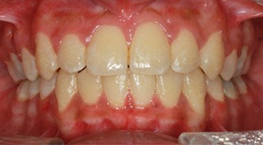 After braces orthodontic treatment at Dentist of Montclair
