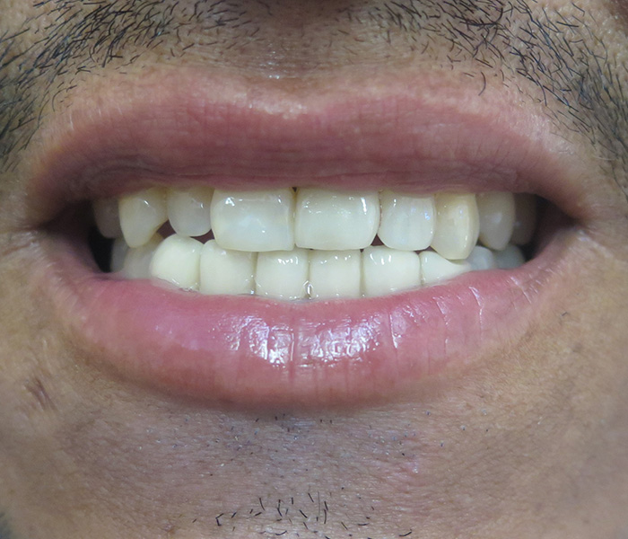 After cosmetic veneers treatment at Dentist of Montclair