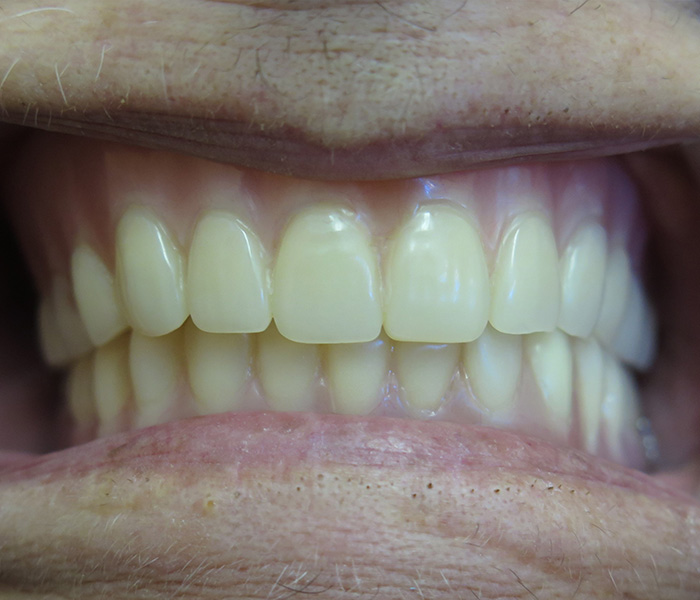 After all-on-4 dental implants at Dentist of Montclair