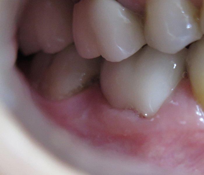 After dental crown treatment at Dentist of Montclair