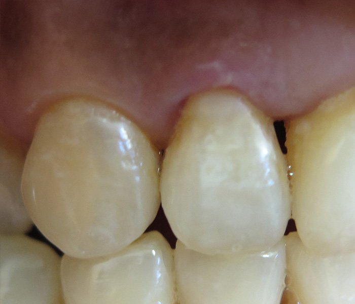 After decayed teeth restored with composite fillings at Dentist of Montclair