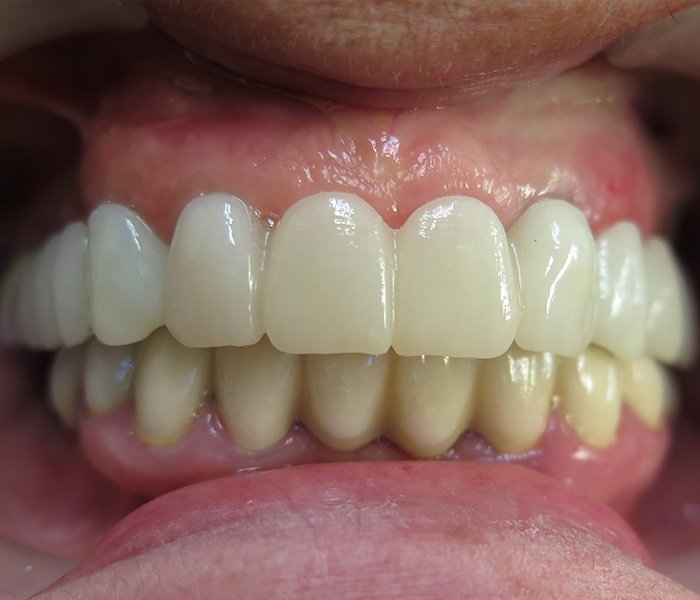 After full dental implant restoration at Dentist of Montclair