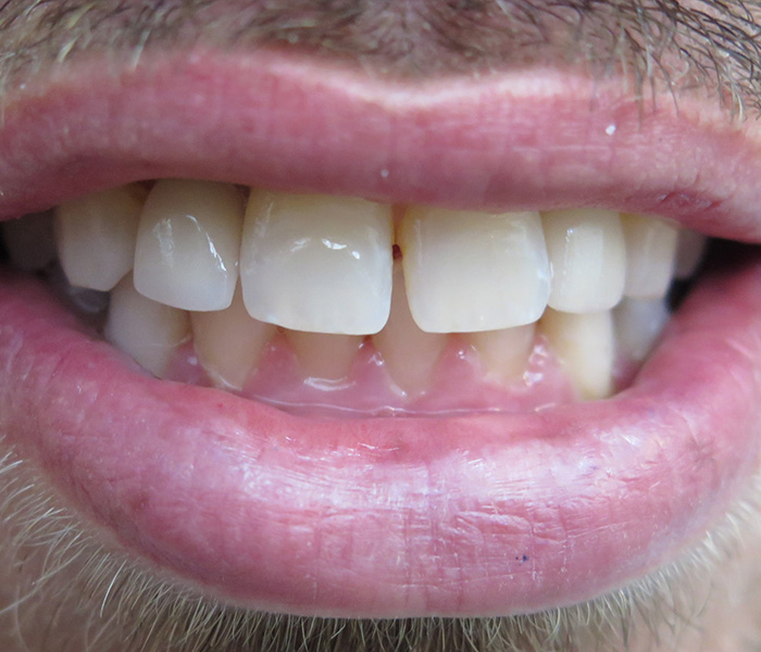 After implant-supported smile makeover at Dentist of Montclair