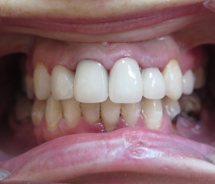 After single dental implant treatment at Dentist of Montclair