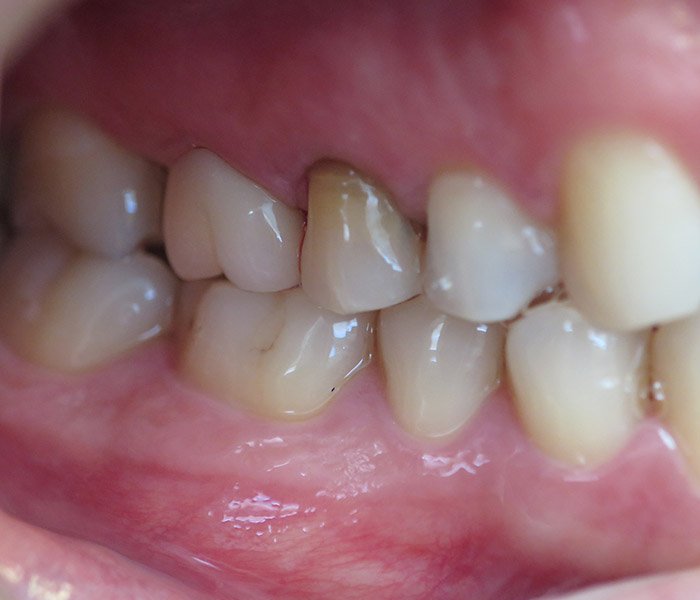 After front tooth dental crown at Dentist of Montclair