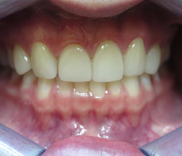 After porcelain veneer smile makeover at Dentist of Montclair
