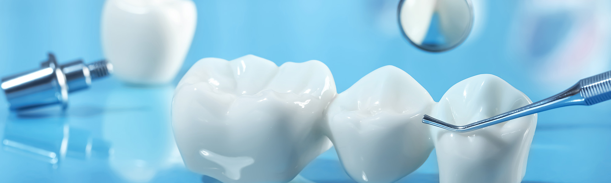 What Are the Types of Dental Bridges in Montclair CA