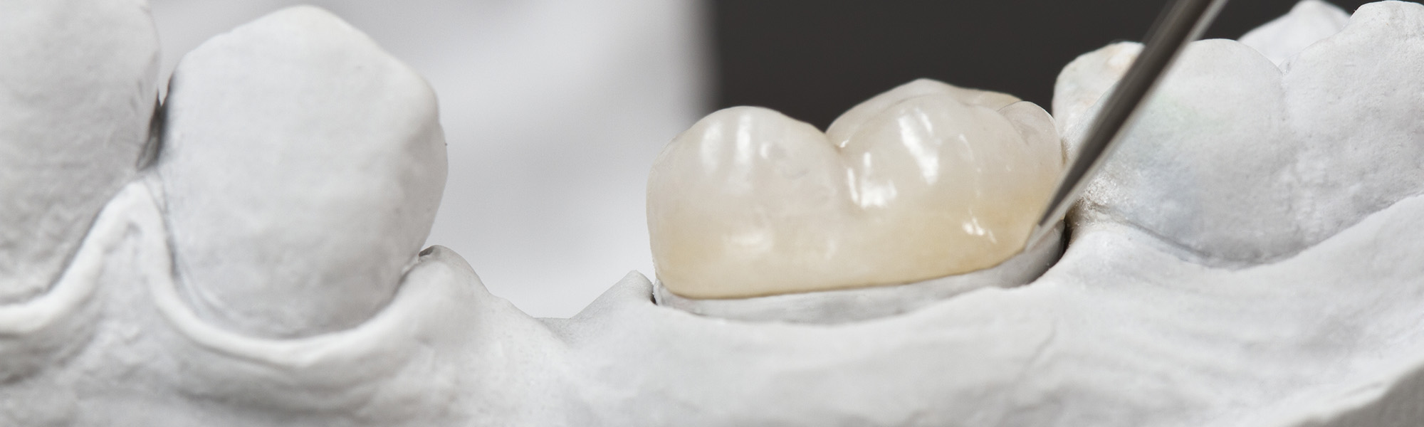 Understanding Inlays and Onlays in Montclair CA