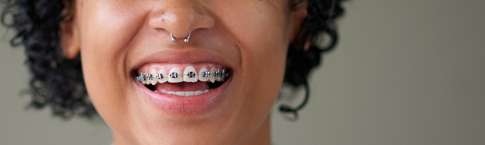 What are Metal Braces Montclair CA