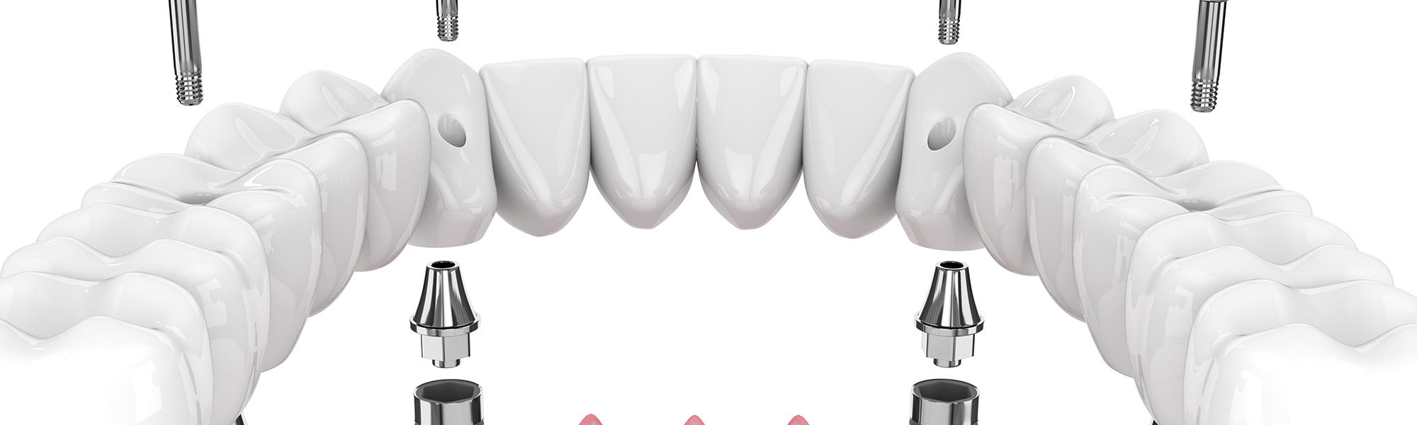 What Are Bridge Dental Implants in Montclair CA